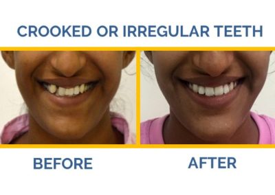Want to get your crooked teeth fixed by the best dentist in Delhi? Visit The Caring Touch, the best dental clinic in Delhi for clear aligners and invisalign solutions.
