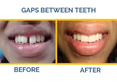 Suffering from gaps between your teeth? Visit The Caring Touch Dental Clinic, the best dental clinic in Delhi for implants, invisalign, braces?