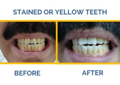 Are you feeling embarrassed about your stained or yellow teeth? Visit The Caring Touch Dental Clinic, the best dental clinic in Delhi for the best teeth whitening solutions.