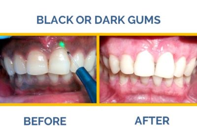 Are your gums dark or blackened? Visit The Caring Touch Dental Clinic, the best dental clinic in Delhi for the best gum treatments.