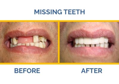 Do you have missing teeth? Visit The Caring Touch Dental Clinic, the best dental clinic in Delhi for dental implants treatments.