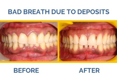Suffering from bad breath? Visit The Caring Bauch Dental Clinic, the best dental clinic in Delhi.