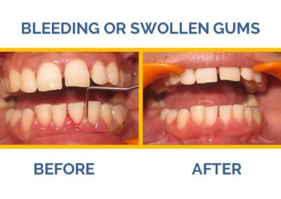 Suffering from bleeding gums? Visit The Caring Bluch Dental Clinic, the best dental clinic in Delhi.