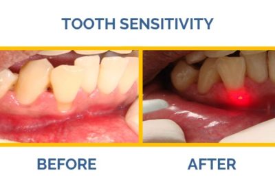 Suffering from tooth sensitivity? Visit The Caring Touch Dental Clinic, the best dental clinic in Delhi.